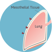 fiberslodgeinmesothelialtissue.png